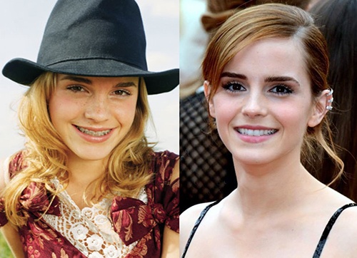 Adult Braces Emma Watson-1