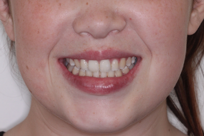 before and after braces