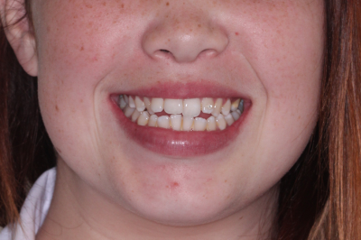 before and after braces