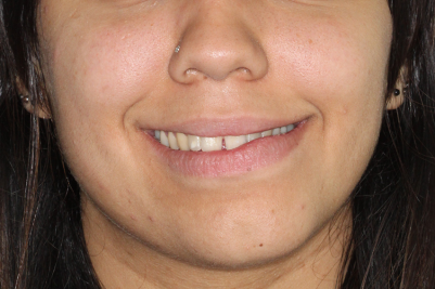 braces sydney before after 
