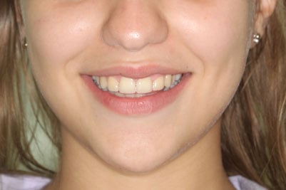 before and after braces