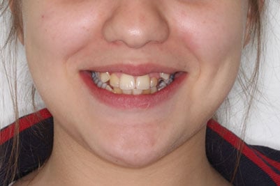 before and after braces