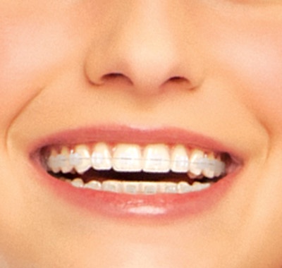 IWO-ceramic-braces-treatments.jpg