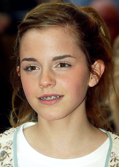 Celebrities Who Had Braces - Emma Watson